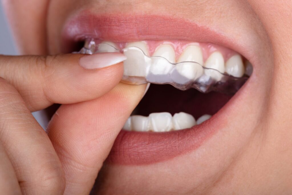 Invisalign in Sparta