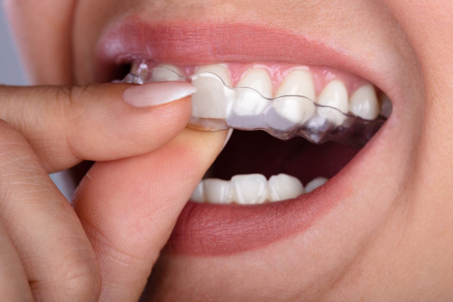 Invisalign in Sparta