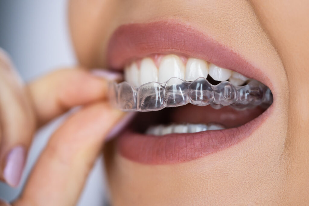 crooked teeth orthodontic treatment in Sparta