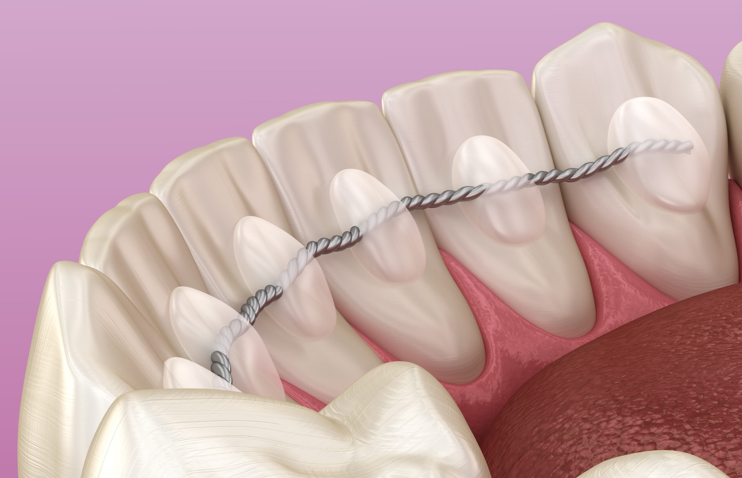 Lingual Braces in Sparta