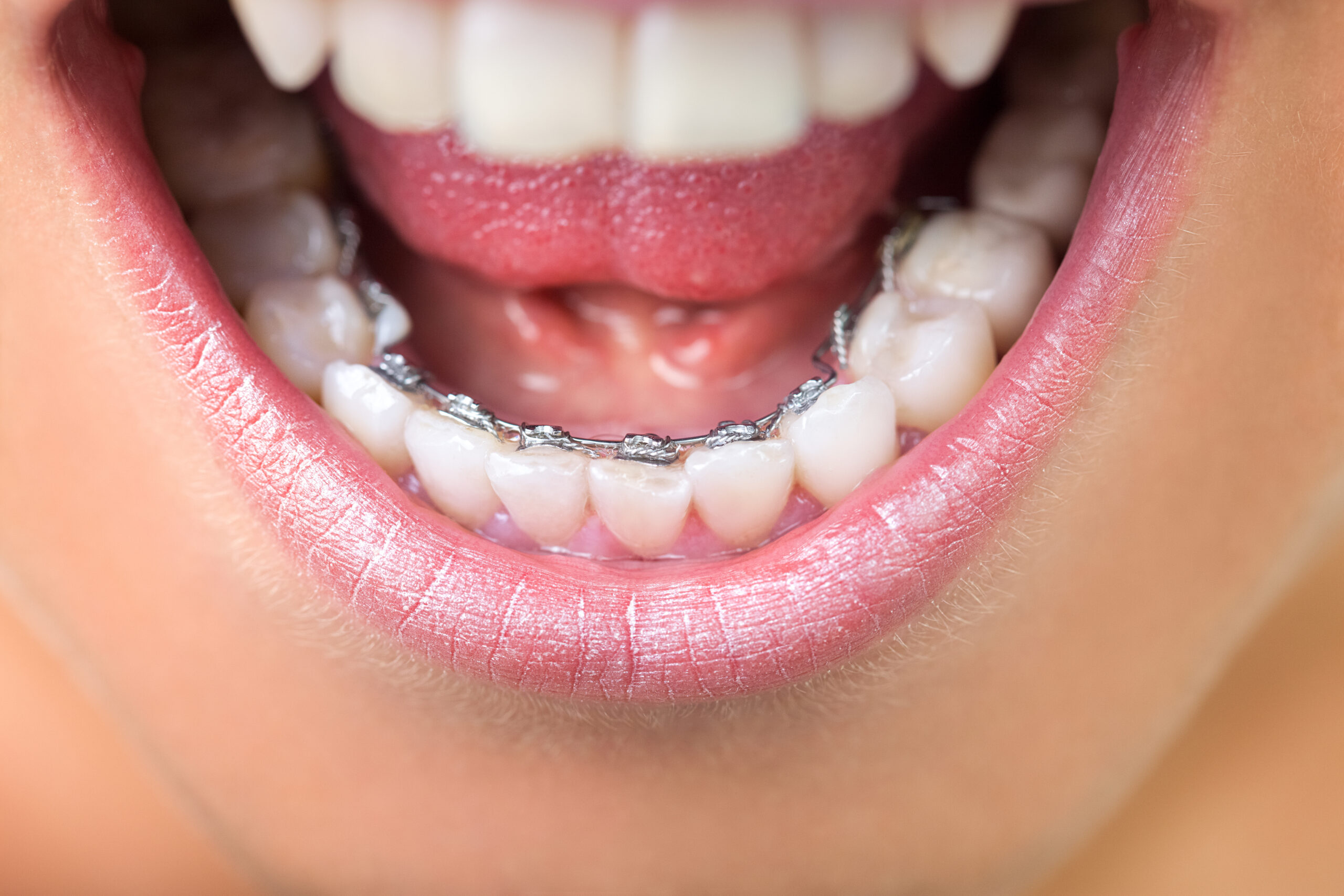 phase 1 orthodontic treatment Early Functional Orthodontics in Sparta
